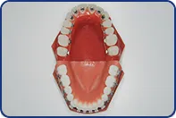 リンガルブラケット矯正装置(舌側矯正)＋マルチブラケット装置(表側矯正)